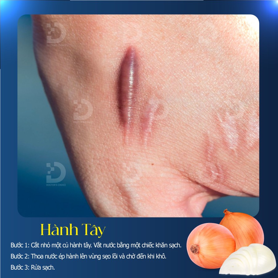 Phòng khám trị sẹo lồi, sẹp phì đại tại TPHCM an toàn, hiệu quả 21 Điều trị sẹo lồi bằng hành tây