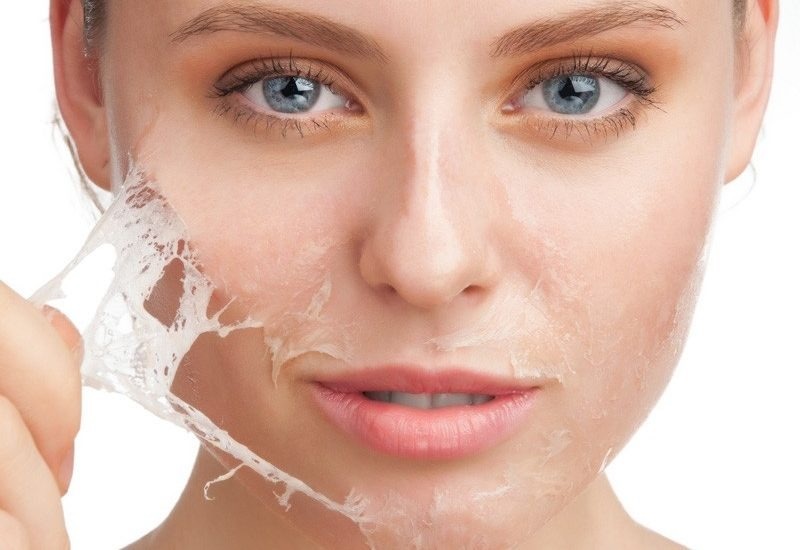 Phòng Khám Thâm Mụn Tại HCM An Toàn, Hiệu Quả 16 Trị thâm mụn bằng phương pháp lột da hóa học (Chemical peeling)