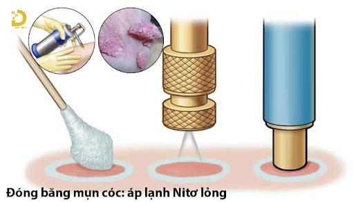 Phòng khám điều trị mụn cóc TPHCM nhanh, an toàn, hiệu quả 17 Áp lạnh là phương pháp sử dụng nitơ lỏng có nhiệt độ -196°C để đông lạnh và tiêu diệt tế bào mụn cóc