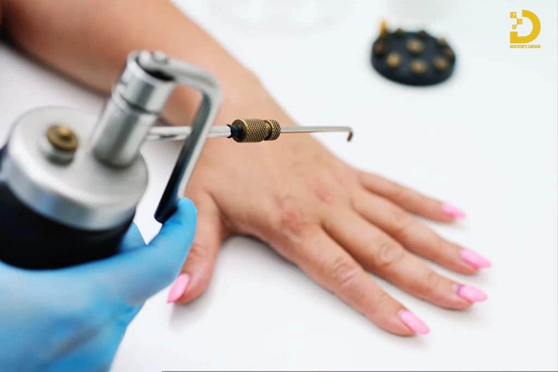 Phòng khám điều trị mụn cóc TPHCM nhanh, an toàn, hiệu quả 16 Đốt điện là phương pháp sử dụng dòng điện cao tần để đốt cháy và loại bỏ mụn cóc