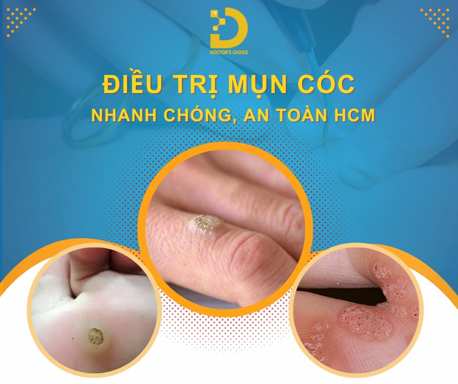 Phòng khám điều trị mụn cóc TPHCM nhanh, an toàn, hiệu quả 11 Doctor's Choice Clinic mang đến dịch vụ điều trị mụn cóc tiên tiến, an toàn và hiệu quả.