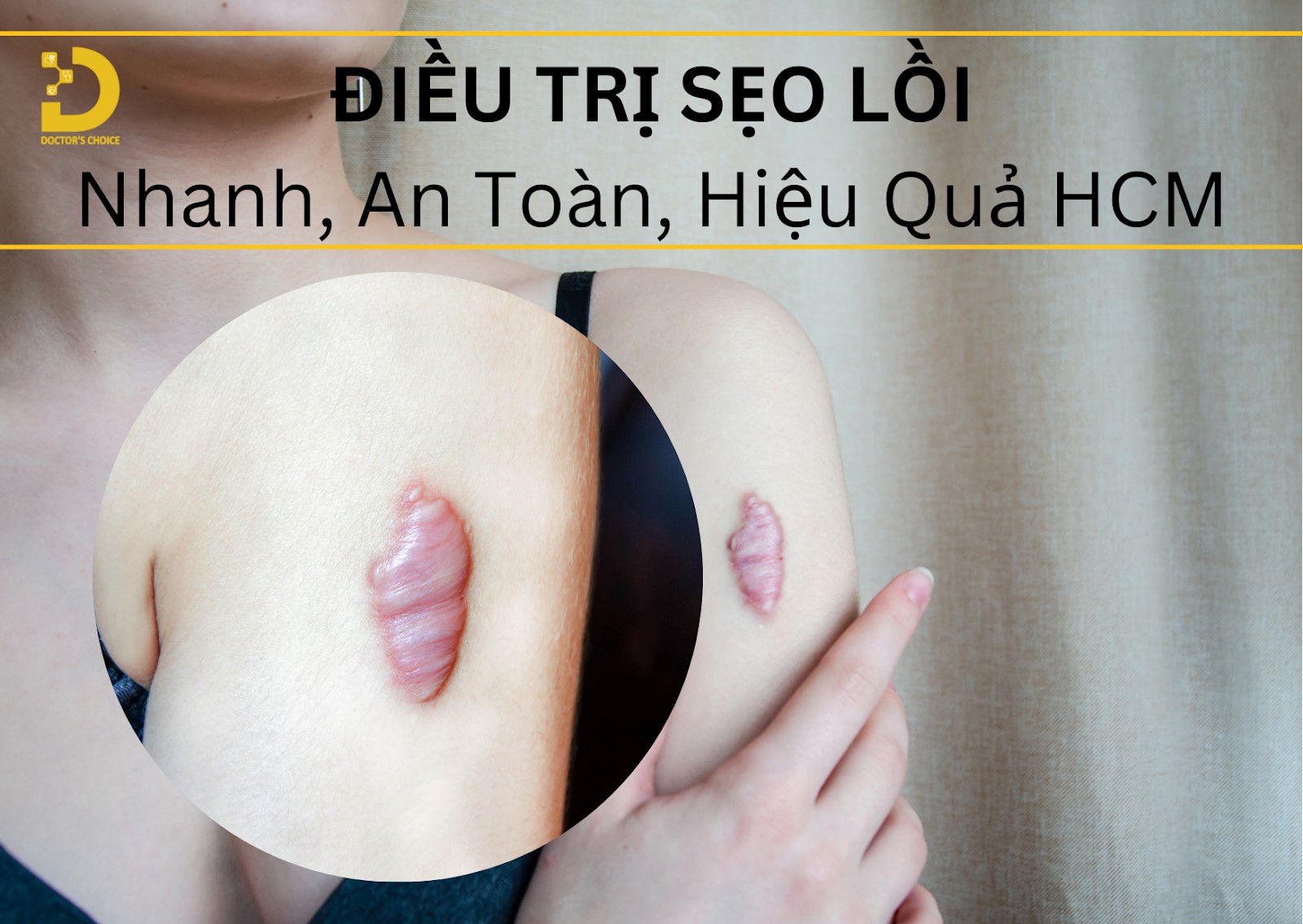 Phòng khám trị sẹo lồi, sẹp phì đại tại TPHCM an toàn, hiệu quả 19 Dịch vị điều trị sẹo lồi hiệu quả tại HCM