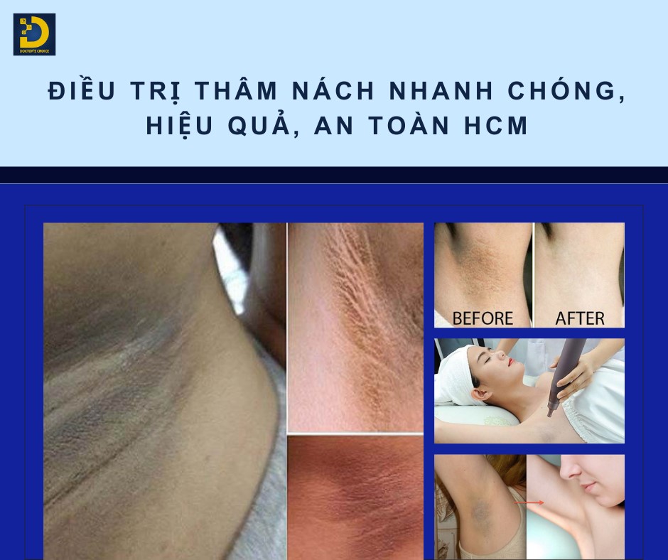 Phòng khám điều trị thâm nách tại TPHCM an toàn, hiện quả 6 Điều trị thâm nách