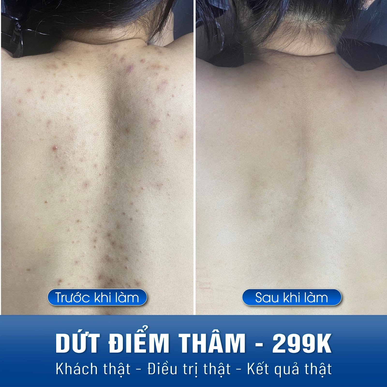 Điều Trị Mụn Lưng An Toàn, Vệ Sinh Chuẩn Y Khoa TPHCM 26 hinh anh ket qua tri mun lung 2