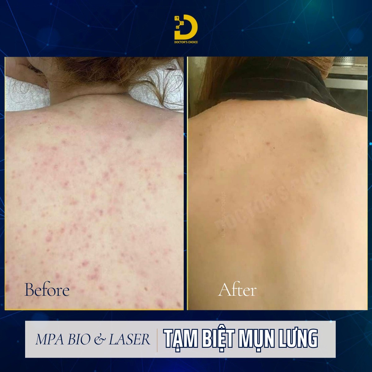 Điều Trị Mụn Lưng An Toàn, Vệ Sinh Chuẩn Y Khoa TPHCM 27 hinh anh ket qua tri mun lung 3