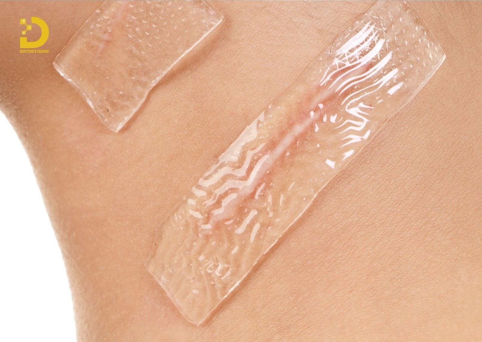 Phòng khám trị sẹo lồi, sẹp phì đại tại TPHCM an toàn, hiệu quả 23 Điều trị sẹo lồi bằng silicon