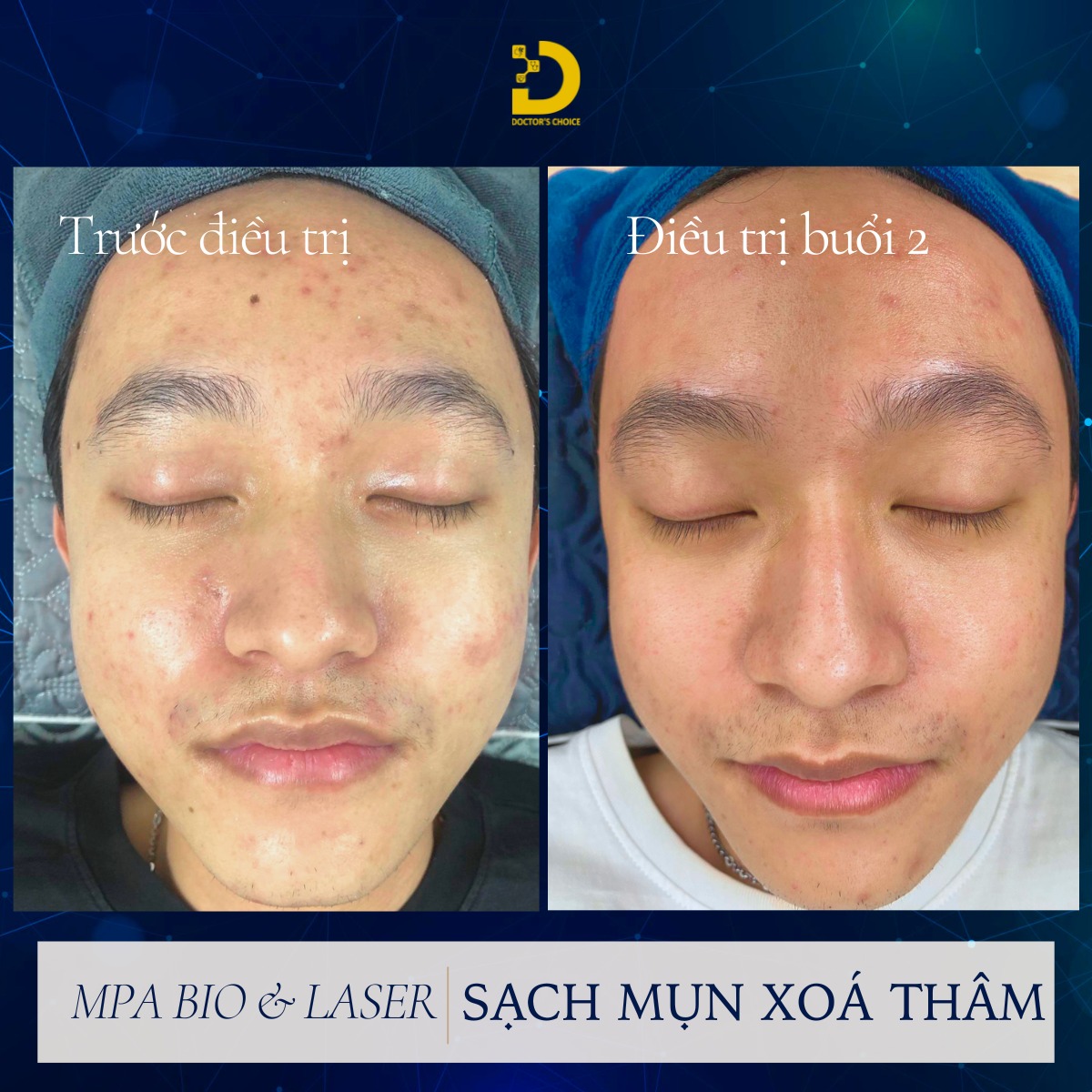 Phòng Khám Thâm Mụn Tại HCM An Toàn, Hiệu Quả 17 Kết quả trị thâm mụn bằng larser kết hợp MPA BIO