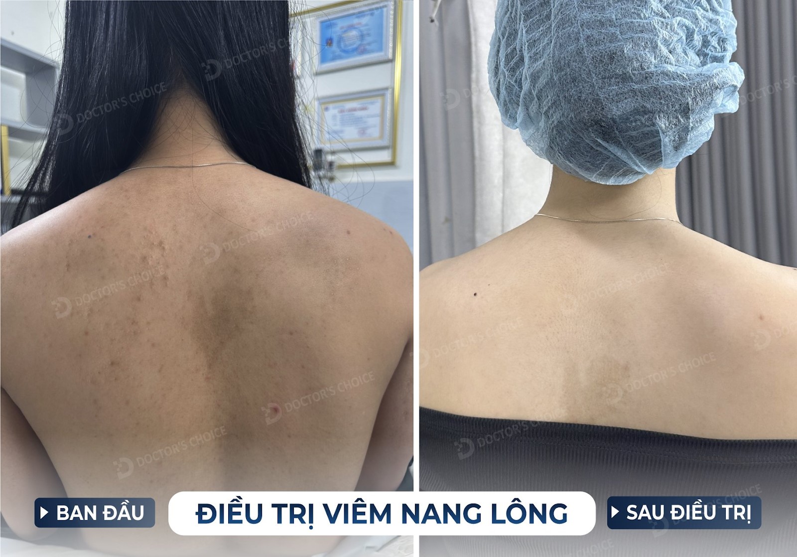 Phòng Khám Điều Trị Viêm Nang Lông Hiệu Quả, An Toàn Tại TPHCM 14 Kết quả điều trị viêm nang lông bằng laser