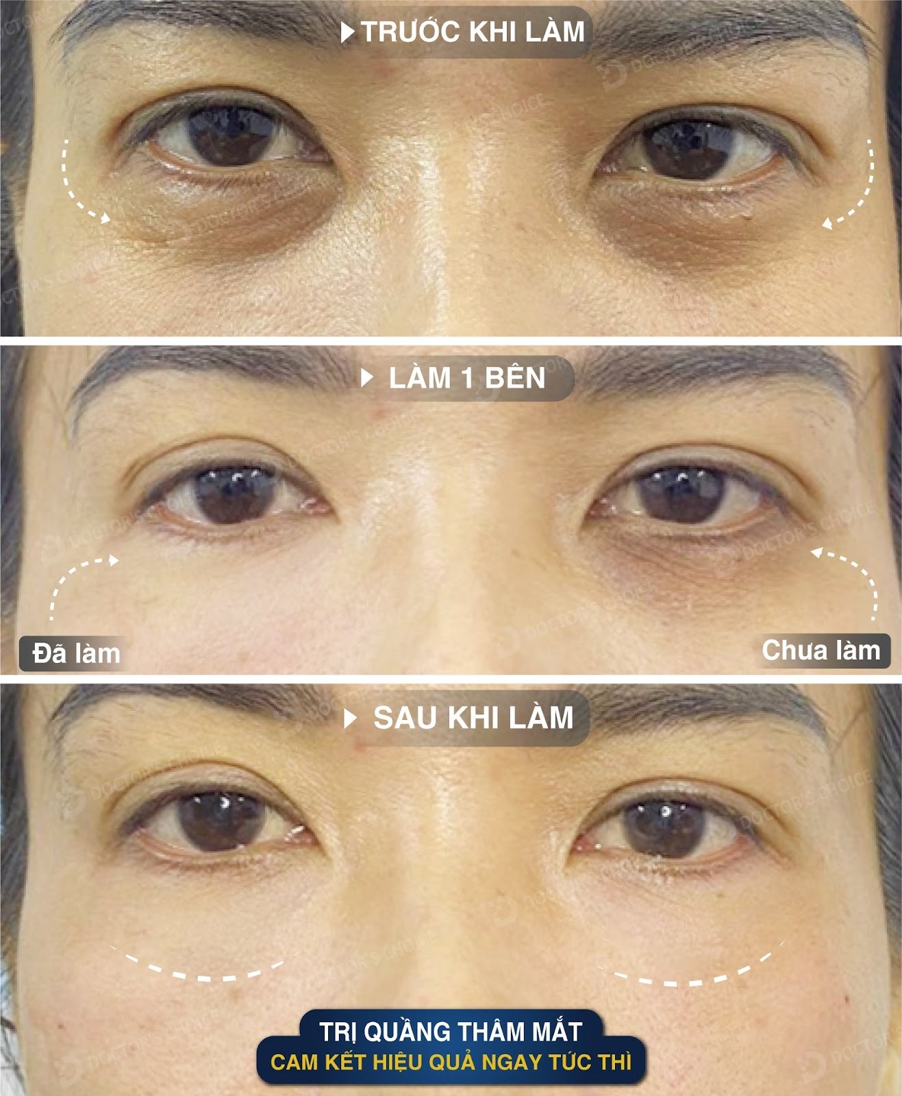 Phòng khám điều trị thâm quầng mắt hiệu quả ở TPHCM 30 ket qua tri tham mat 9