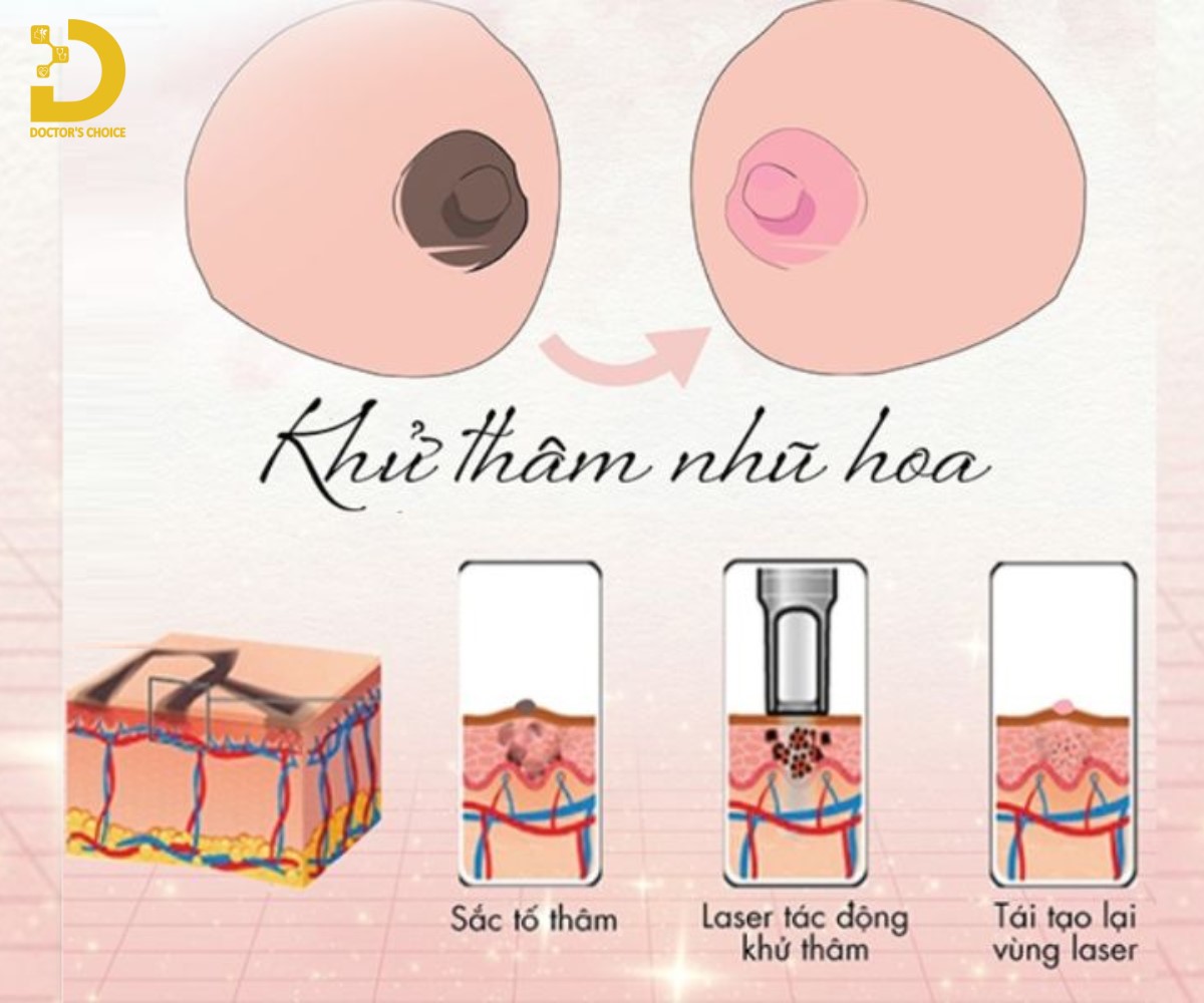 Phòng khám điều trị thâm nhũ hoa ở TPHCM đẹp, kín đáo 14 Làm hồng nhũ hoa bằng Laser
