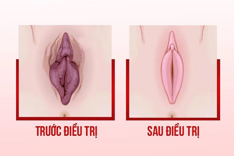 Phòng Khám Làm Hồng "Cô Bé" Ở HCM Đẹp, Nhanh, Không Đau 8 lam hong co be 2