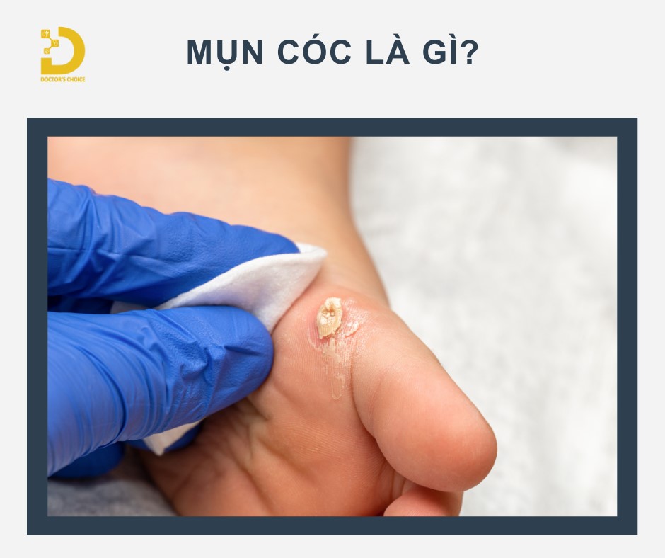 Phòng khám điều trị mụn cóc TPHCM nhanh, an toàn, hiệu quả 12 Mụn cóc (Verruca) là tổn thương da dạng sùi, gồ ghề, thường có màu hơi ngả vàng hoặc nâu