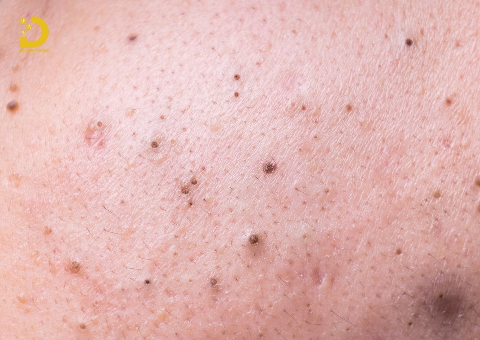Điều Trị Mụn Lưng An Toàn, Vệ Sinh Chuẩn Y Khoa TPHCM 17 Mụn lưng đầu đen