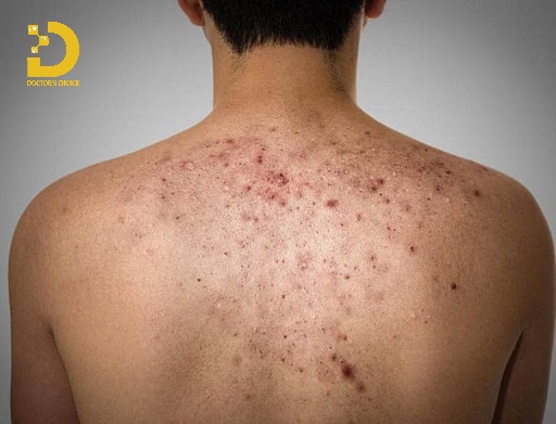 Điều Trị Mụn Lưng An Toàn, Vệ Sinh Chuẩn Y Khoa TPHCM 16 Mụn lưng (bacne) là tình trạng viêm nang lông xảy ra trên vùng da lưng