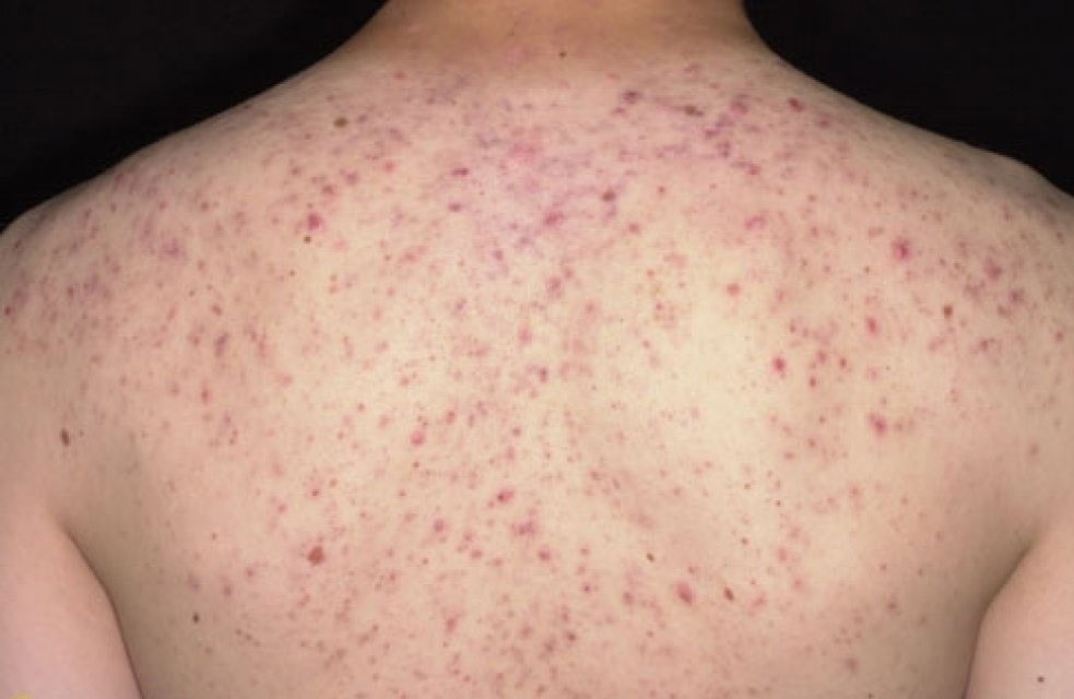 Điều Trị Mụn Lưng An Toàn, Vệ Sinh Chuẩn Y Khoa TPHCM 18 Mụn lưng sưng viêm (Papules)