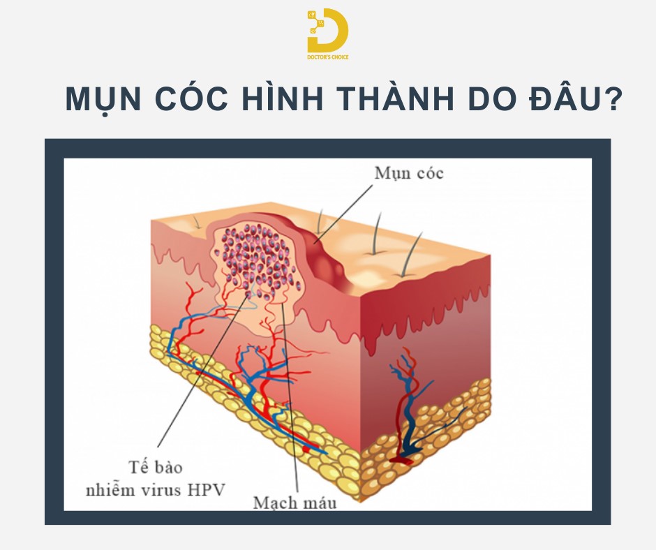 Phòng khám điều trị mụn cóc TPHCM nhanh, an toàn, hiệu quả 13 Nguyên nhân chính gây mụn cóc là do virus HPV xâm nhập vào da qua các vết thương hở.