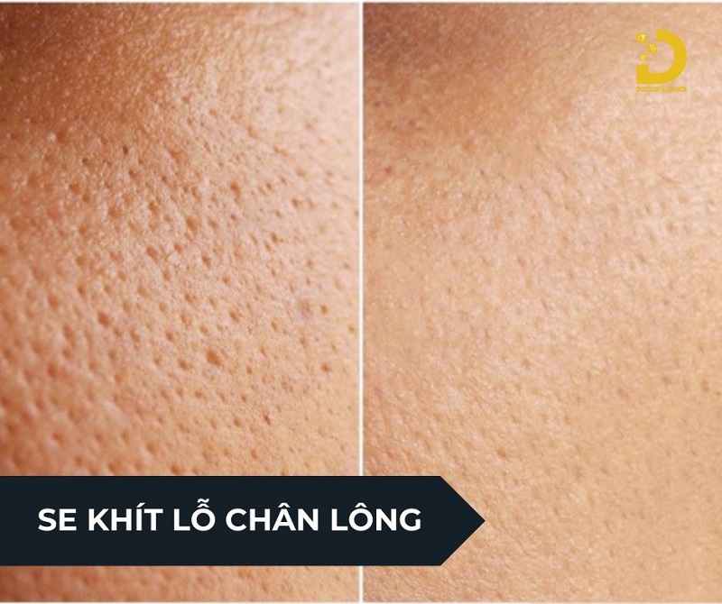 Dịch Vụ Se Khít Lỗ Chân Lông Hiệu Quả, An Toàn Tại TPHCM 8 se khit lo chan long 3