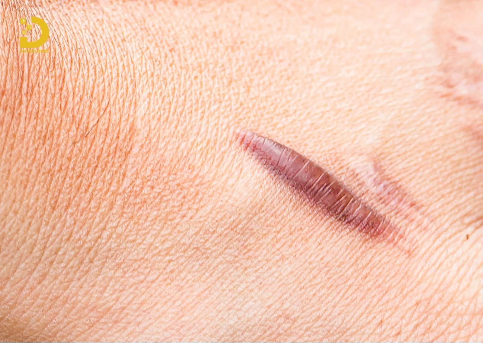 Phòng khám trị sẹo lồi, sẹp phì đại tại TPHCM an toàn, hiệu quả 20 Sẹo lồi (Hypertrophic scar) là một dạng sẹo bất thường