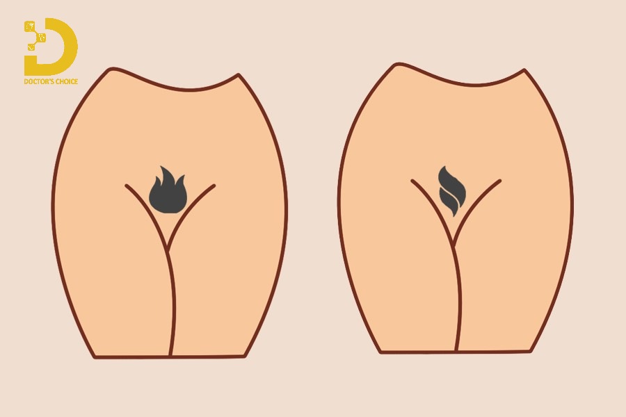 Dịch Vụ Triệt Lông Bikini An Toàn, Giá Tận Gốc Ở TPHCM 12 tạo hình triệt lông bikini được ưa chuộng