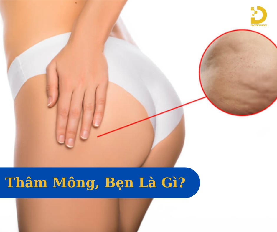 Phòng khám trị thâm mông, bẹn an toàn ở TPHCM 10 Thâm mông và bẹn là tình trạng thay đổi sắc tố da ở vùng mông và bẹn