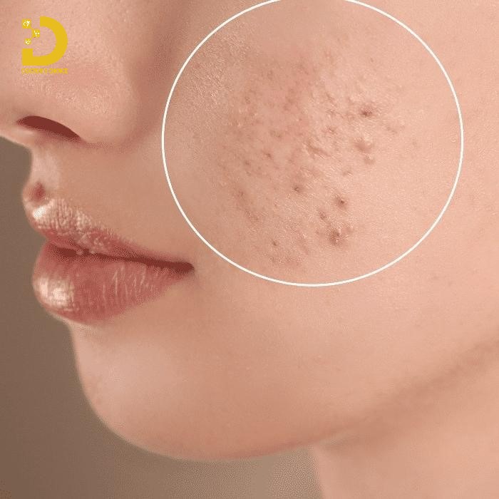 Phòng Khám Thâm Mụn Tại HCM An Toàn, Hiệu Quả 13 Hình ảnh da mặt bị thâm mụn