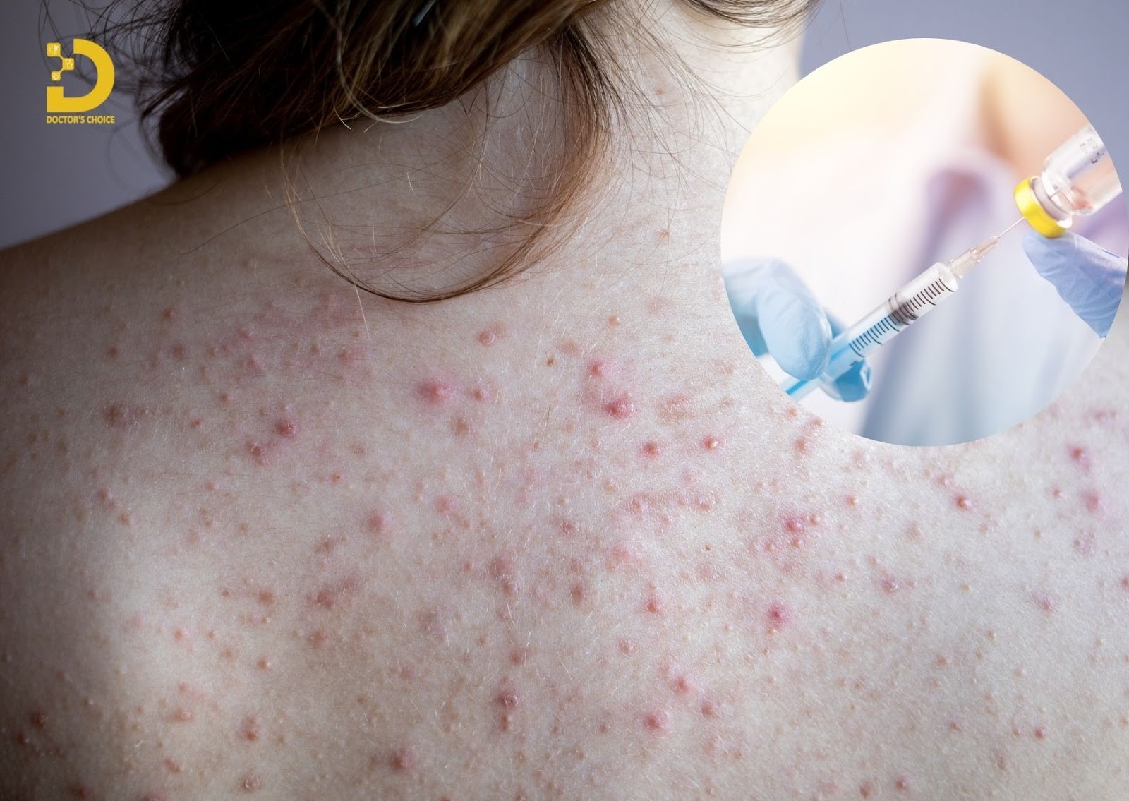 Điều Trị Mụn Lưng An Toàn, Vệ Sinh Chuẩn Y Khoa TPHCM 23 Trị mụn lưng bằng phương pháp tiêm corticosteroid nội tổn thương