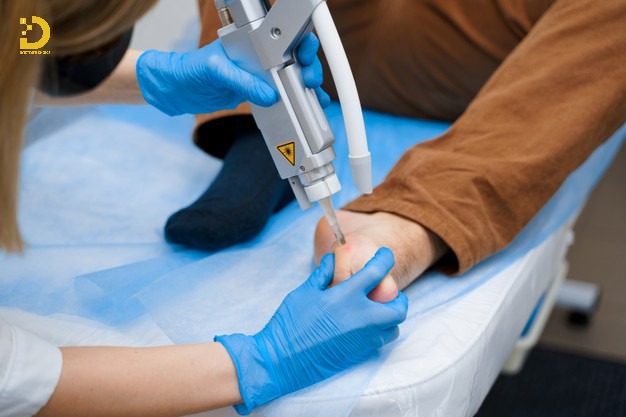Phòng khám điều trị mụn cóc TPHCM nhanh, an toàn, hiệu quả 15 Laser là phương pháp điều trị mụn cóc tiên tiến