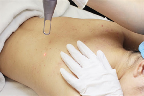 Điều Trị Mụn Lưng An Toàn, Vệ Sinh Chuẩn Y Khoa TPHCM 21 Trị mụn lưng bằng công nghệ Laser CO2 Fractional