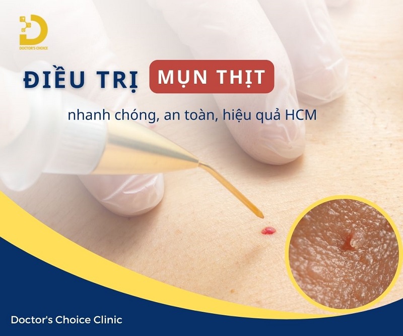 Phòng Khám Điều Trị Mụn Thịt An Toàn, Hiệu Quả TPHCM 13 Điều trị mụn thịt