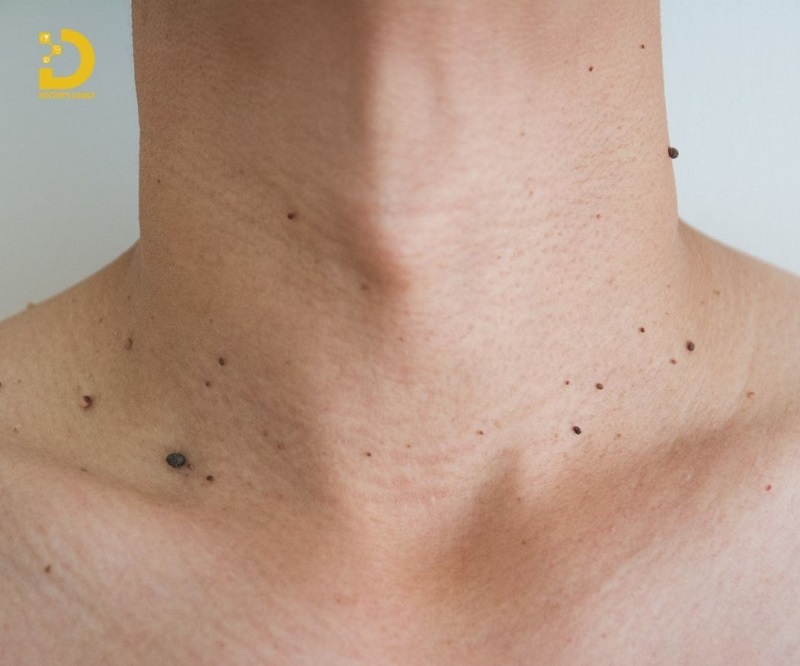 Phòng Khám Điều Trị Mụn Thịt An Toàn, Hiệu Quả TPHCM 14 tri mun thit 2