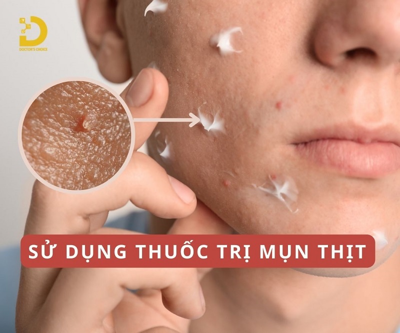 Phòng Khám Điều Trị Mụn Thịt An Toàn, Hiệu Quả TPHCM 18 tri mun thit 6