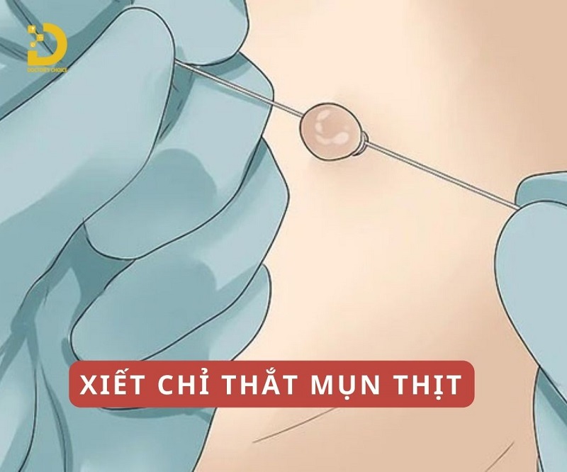 Phòng Khám Điều Trị Mụn Thịt An Toàn, Hiệu Quả TPHCM 19 tri mun thit 7