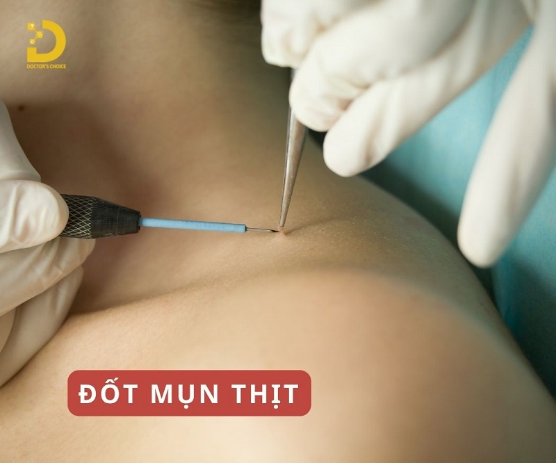 Phòng Khám Điều Trị Mụn Thịt An Toàn, Hiệu Quả TPHCM 20 tri mun thit 8