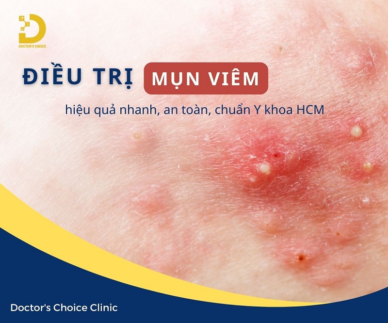 Phòng Khám Điều Trị Mụn Viêm An Toàn, Vệ Sinh TPHCM 10 Điều trị mụn viêm