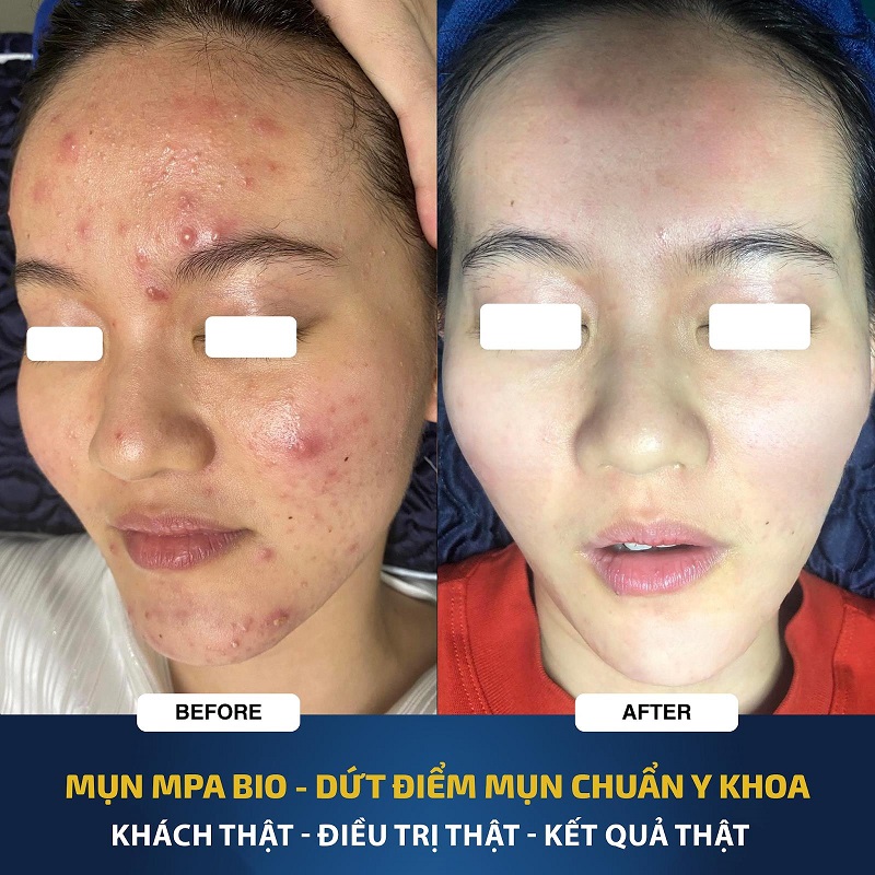 Phòng Khám Điều Trị Mụn Viêm An Toàn, Vệ Sinh TPHCM 13 tri mun viem 4