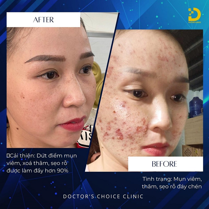Phòng Khám Điều Trị Mụn Viêm An Toàn, Vệ Sinh TPHCM 14 tri mun viem 5