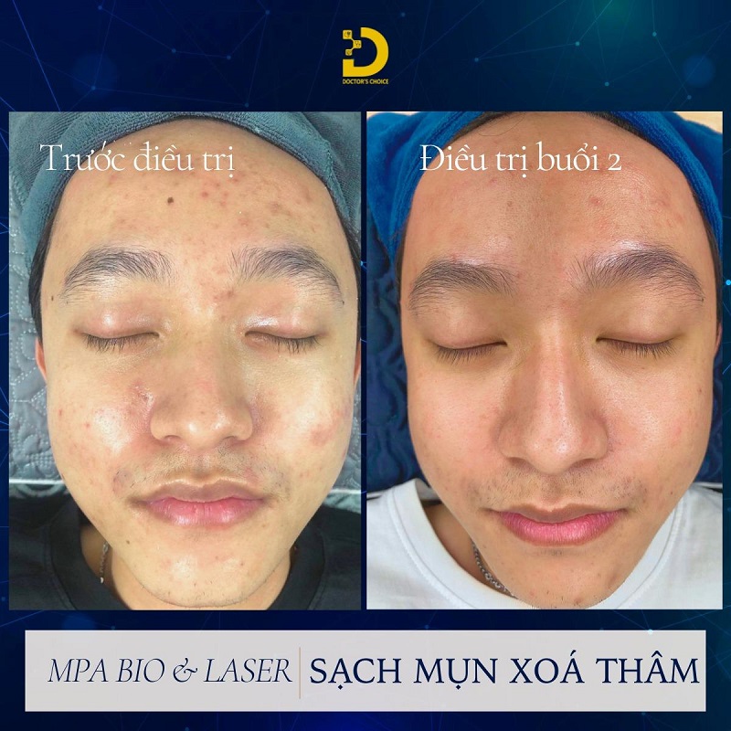 Phòng Khám Điều Trị Mụn Viêm An Toàn, Vệ Sinh TPHCM 16 tri mun viem 7