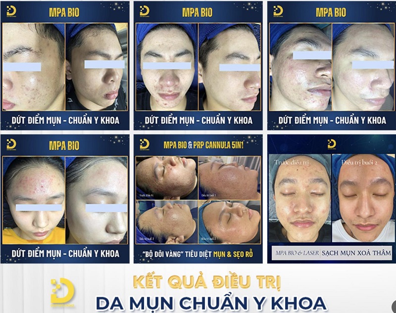 Phòng Khám Điều Trị Mụn Viêm An Toàn, Vệ Sinh TPHCM 17 tri mun viem 8