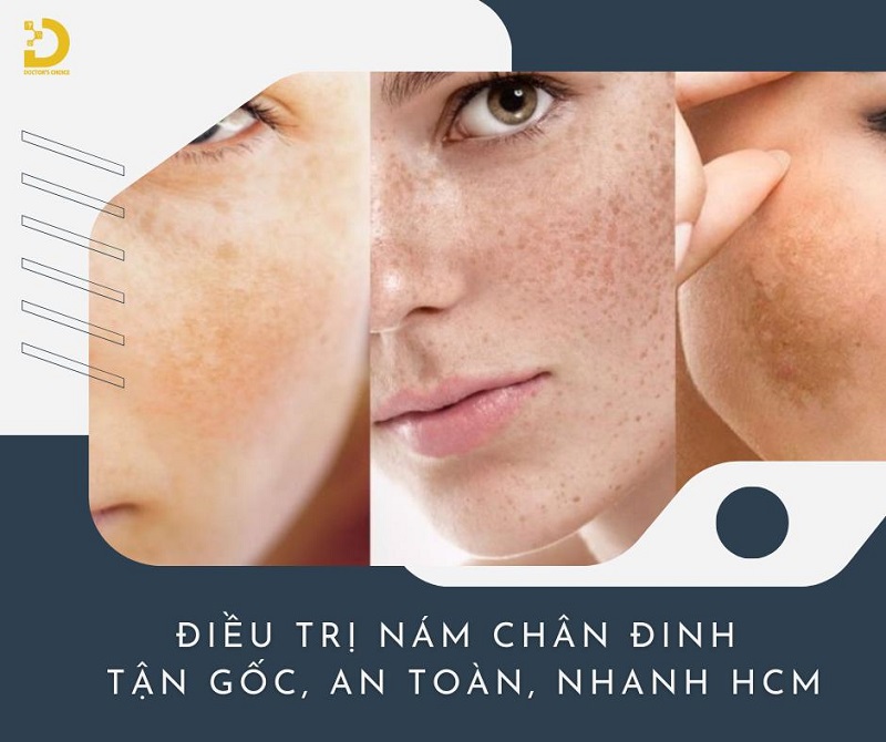 Phòng khám điều trị nám chân đinh hiệu quả ở TPHCM 10 tri nam chan dinh 1