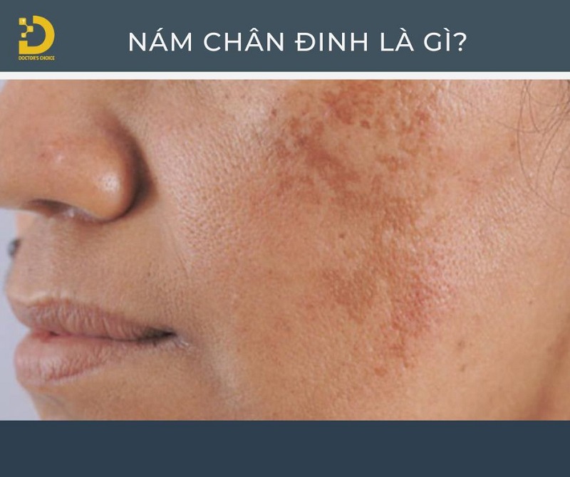 Phòng khám điều trị nám chân đinh hiệu quả ở TPHCM 11 tri nam chan dinh 2