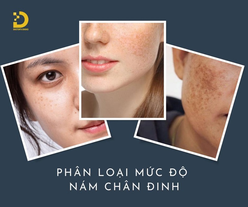 Phòng khám điều trị nám chân đinh hiệu quả ở TPHCM 12 tri nam chan dinh 3