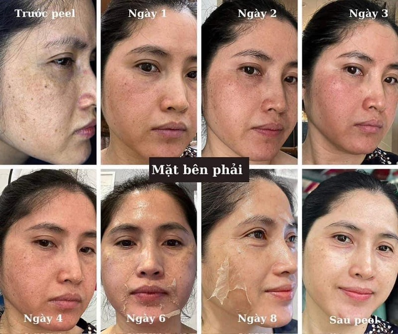 Phòng Khám Điều Trị Nám Mảng Tận Gốc, An Toàn Tại TPHCM 14 tri nam mang 3