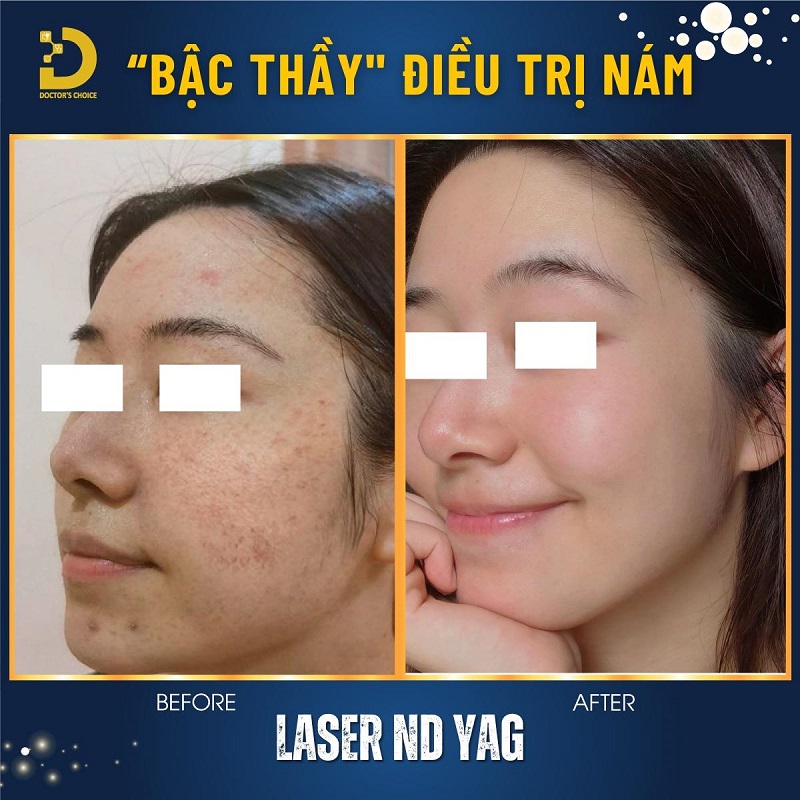 Phòng Khám Điều Trị Nám Mảng Tận Gốc, An Toàn Tại TPHCM 15 tri nam mang 4