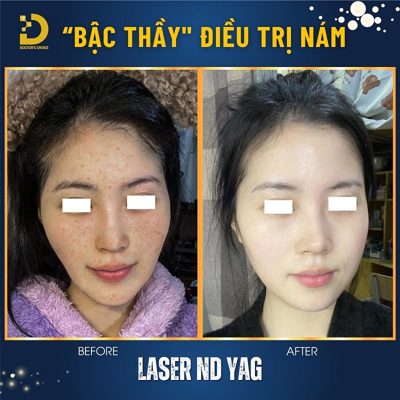 Phòng Khám Điều Trị Nám Mảng Tận Gốc, An Toàn Tại TPHCM 16 tri nam mang 5