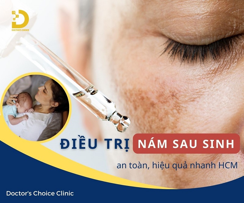 Phòng khám điều trị nám sau sinh ở TPHCM hiệu quả 11 Điều trị nám sau sinh