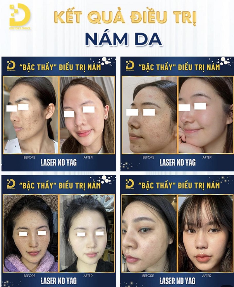 Phòng khám điều trị nám sau sinh ở TPHCM hiệu quả 16 tri nam sau sinh 6