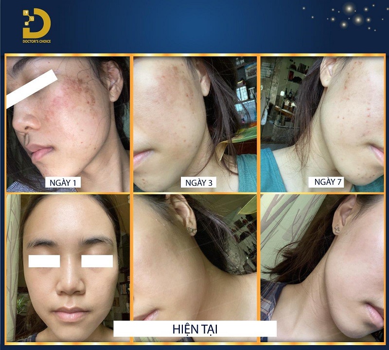Phòng khám điều trị nám sau sinh ở TPHCM hiệu quả 17 tri nam sau sinh 7