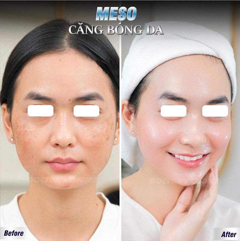 Phòng khám điều trị nám sau sinh ở TPHCM hiệu quả 18 tri nam sau sinh 8