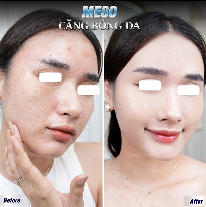 Phòng khám điều trị nám sau sinh ở TPHCM hiệu quả 19 tri nam sau sinh 9