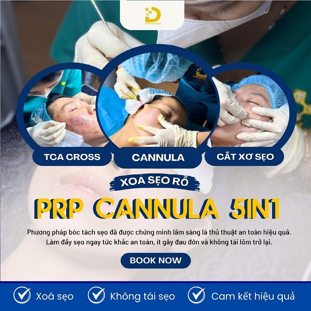 Phòng khám điều trị sẹo rỗ, sẹo lõi nhanh, an toàn tại TPHCM 29 Quy trình điều trị sẹo rỗ/ sẹo lõm chuyên nghiệp
